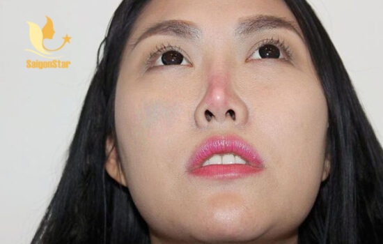 Cách khắc phục lòi sụn sau nâng mũi giúp phòng ngừa biến chứng